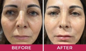 Hydralyft Face Mask Jennifer
