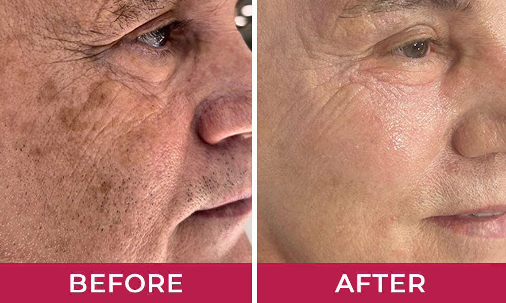 Hydralyft Face Mask benefits